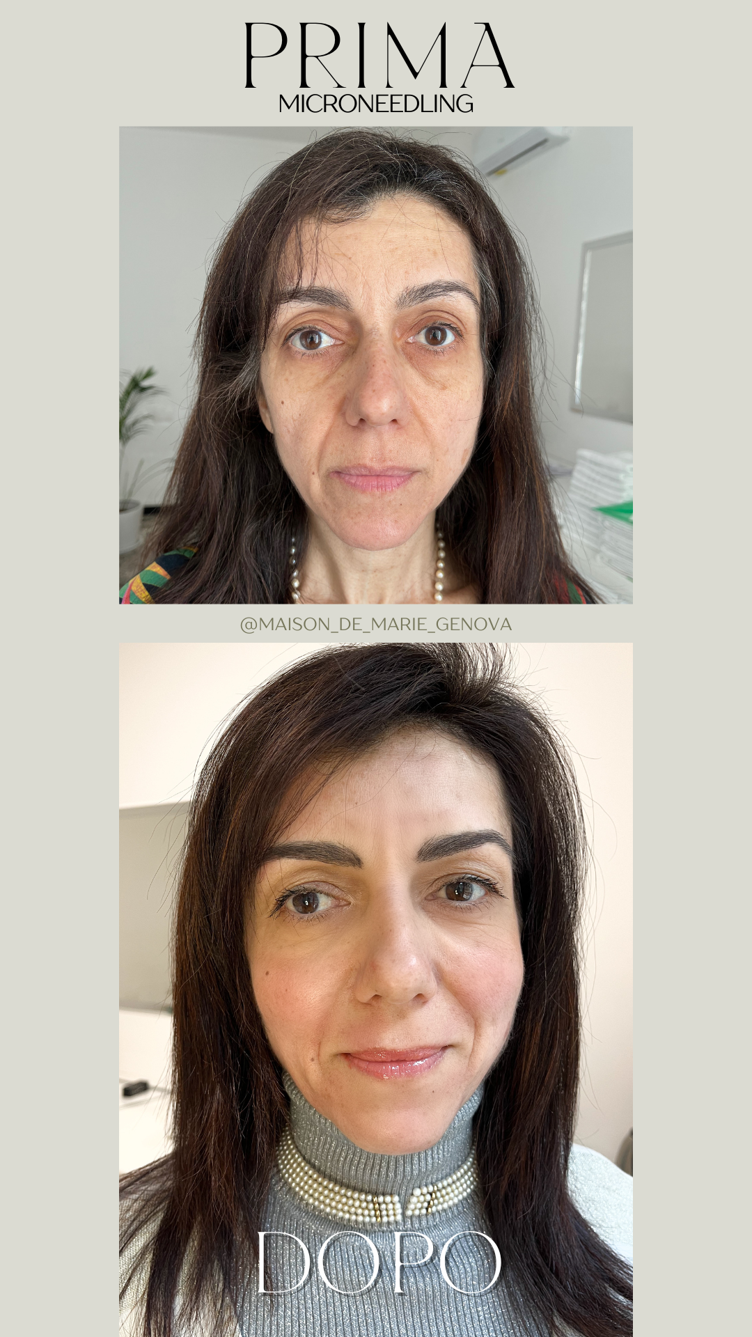 Microneedling (metodo Marie) Genova