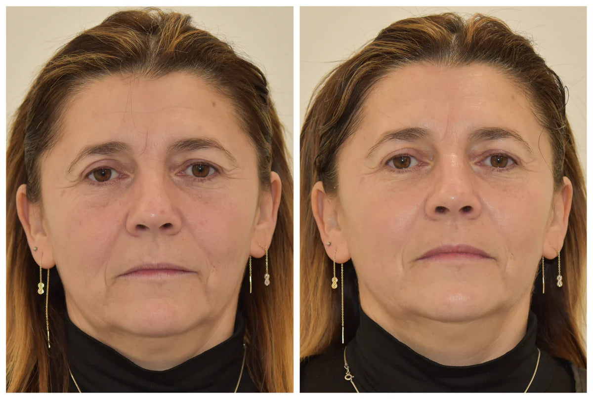 IMAGE MD RESTORING BRIGHTENING CREMA CORRETTIVA