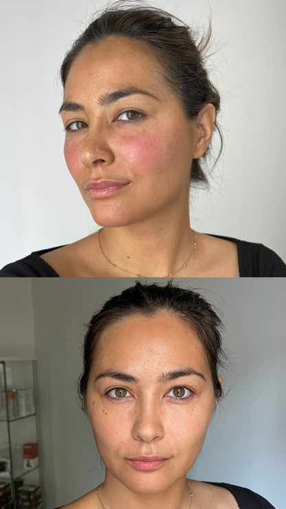 Peeling viso Chimico (metodo Marie)