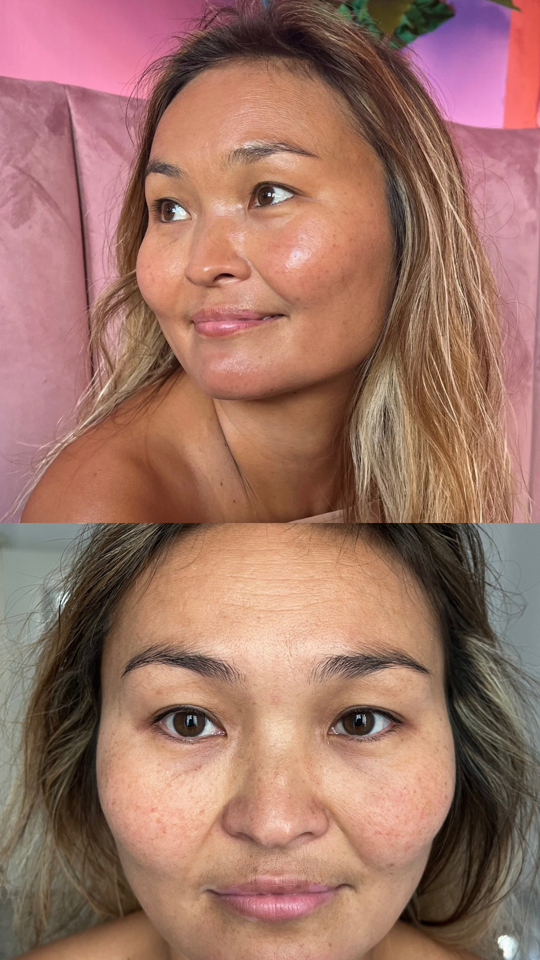 Peeling viso Chimico (metodo Marie)