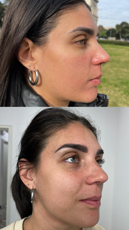 Peeling viso Chimico (metodo Marie)