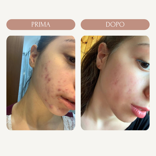 Trattamento ANTI ACNE (metodo Marie)