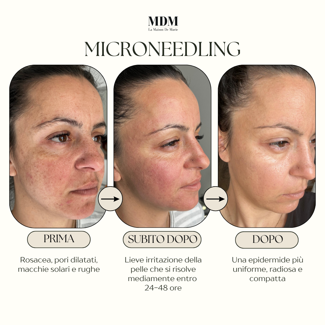 Microneedling (metodo Marie) Genova
