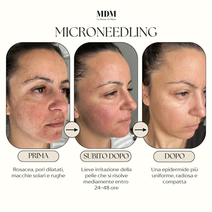 Microneedling (metodo Marie) Genova