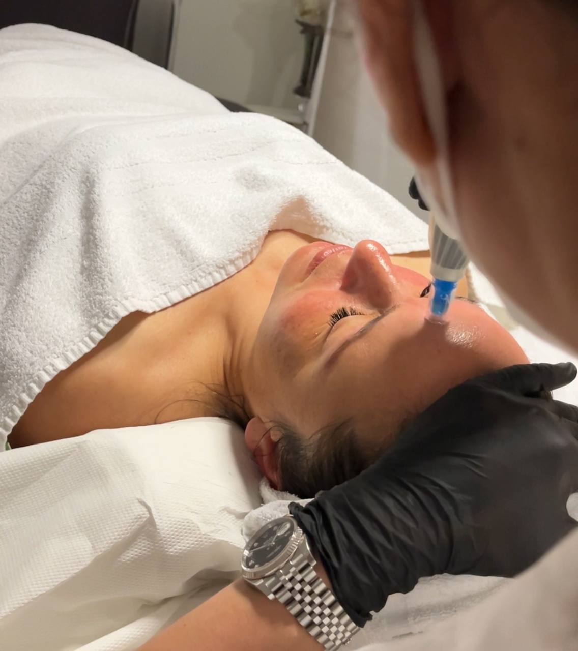Microneedling (metodo Marie) Genova