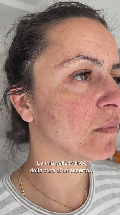 Microneedling (metodo Marie) Genova