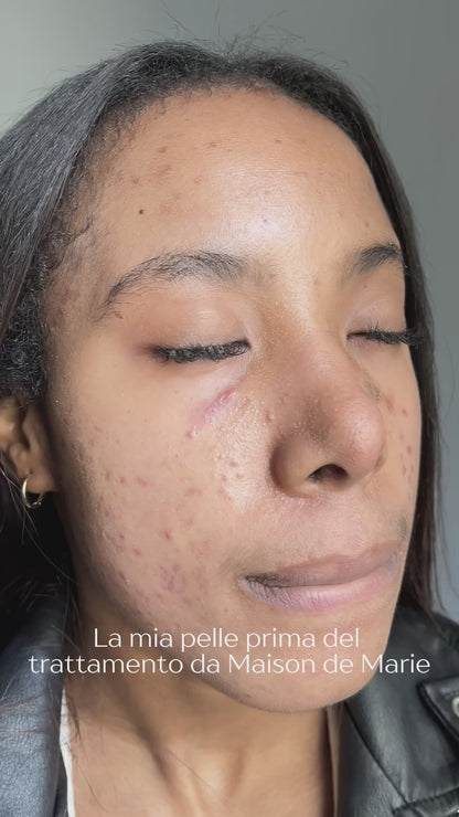 Trattamento ANTI ACNE professionali a Genova Centro (metodo Marie)