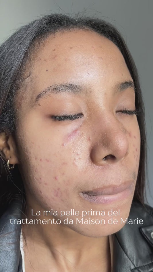 Trattamento ANTI ACNE professionali a Genova Centro (metodo Marie)
